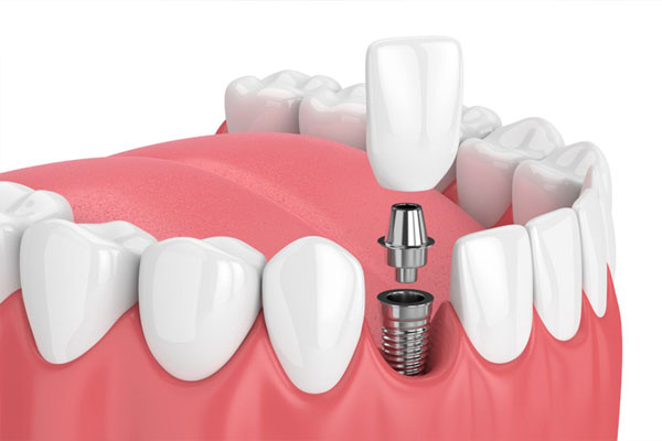 adelaide teeth implants near me dentist